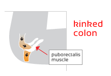 diagrams-kinked-colon